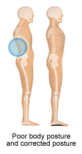 Bad Posture and Orthotics Corrected Posture