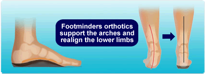 Orthotic Correction- Foot Pronation