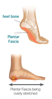 Calcaneus deals pain running