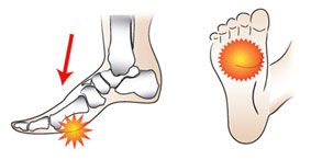 Metatarsalgia - Ball of Foot Pain