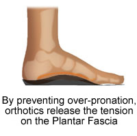 Orthotics Correction for Plantar Fasciitis