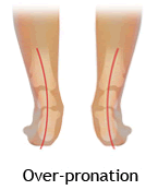 Foot Over-Pronation