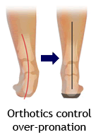 Orthotic insoles prevent flat feet over-pronation